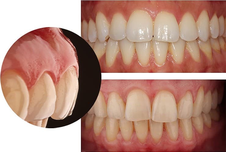 Periodontal disease